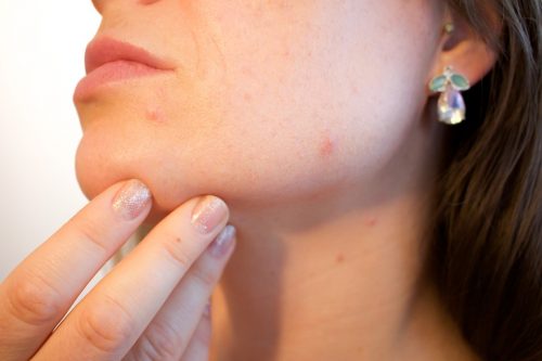 face acne remedy?